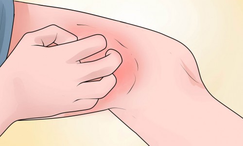 ΦΥΣΙΚΟΙ ΤΡΟΠΟΙ ΓΙΑ ΝΑ ΑΝΤΙΜΕΤΩΠΙΣΕΤΕ ΤΟ ΕΚΖΕΜΑ